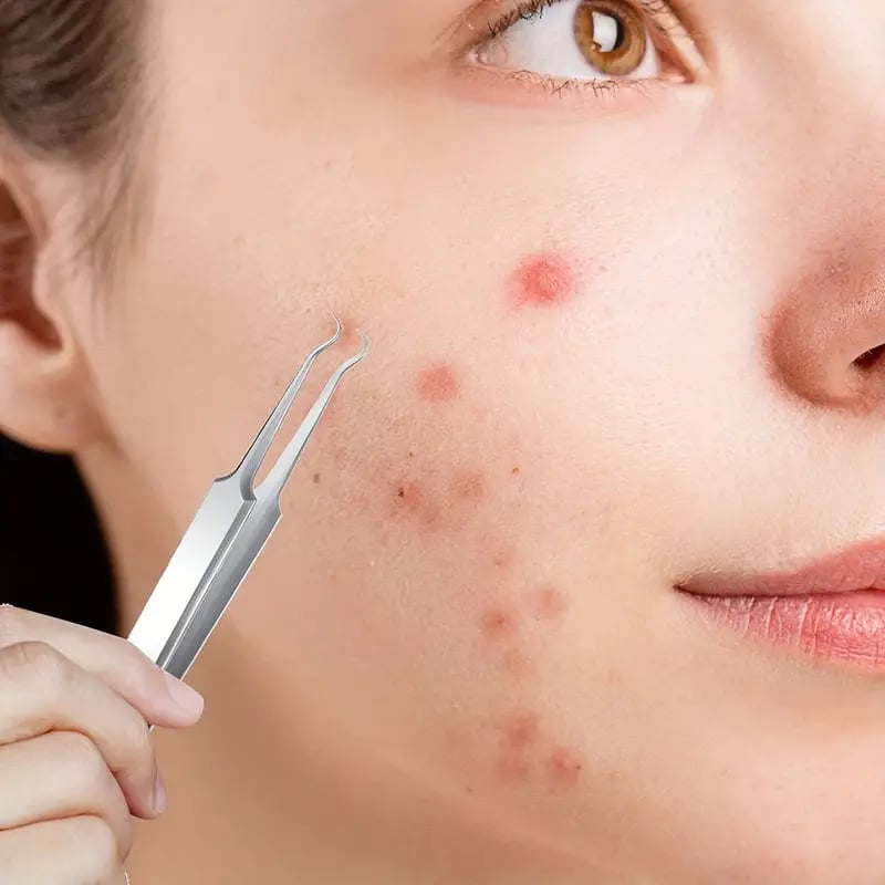 ClearSkin | Vous permet d'éliminer facilement les points noirs et l'acné les plus tenaces