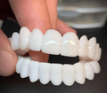 SmileFlex – Prothèse Dentaire Personnalisable avec Lentilles Dentaires